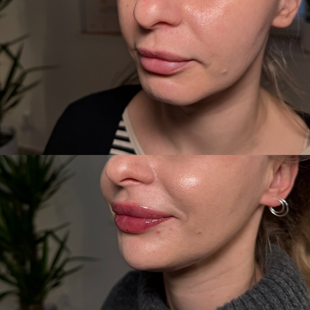 Modelowanie brody i ust — efekt before / after
